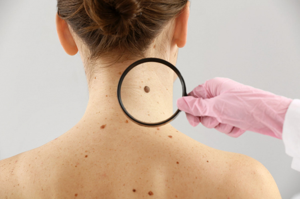 melanoma-of-skin.jpg